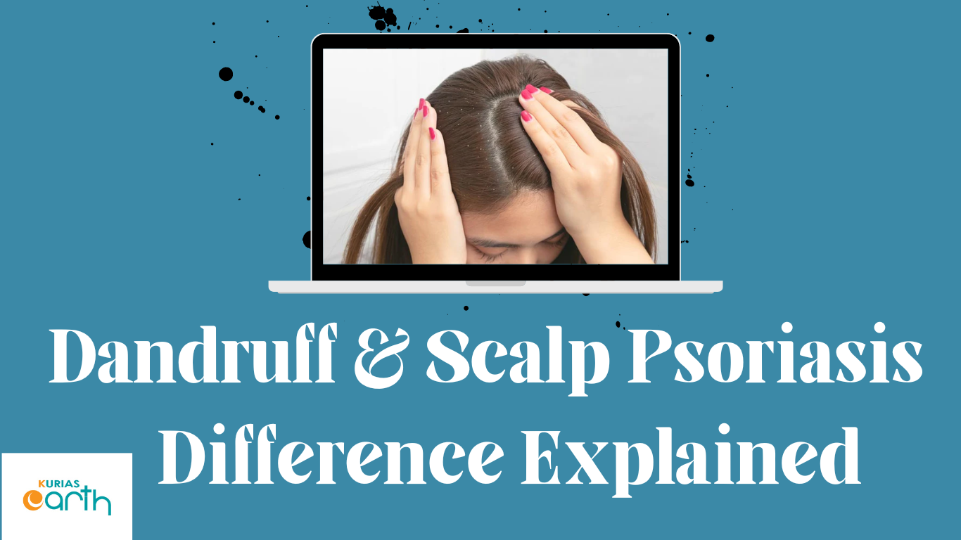 Dandruff & Scalp Psoriasis – Difference Explained