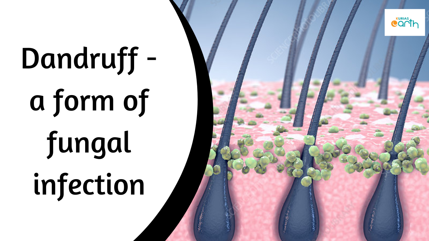 Dandruff – a form of fungal infection