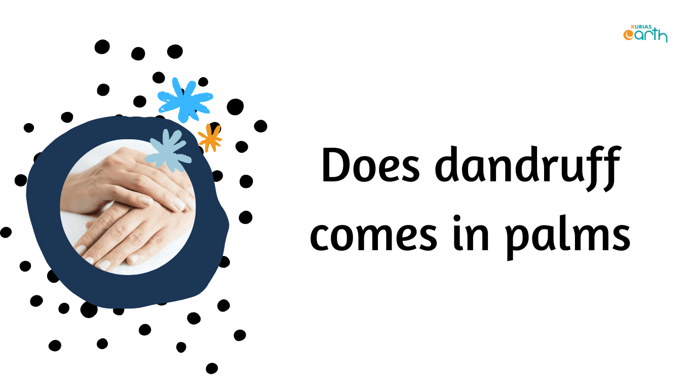 Does dandruff come in palms?