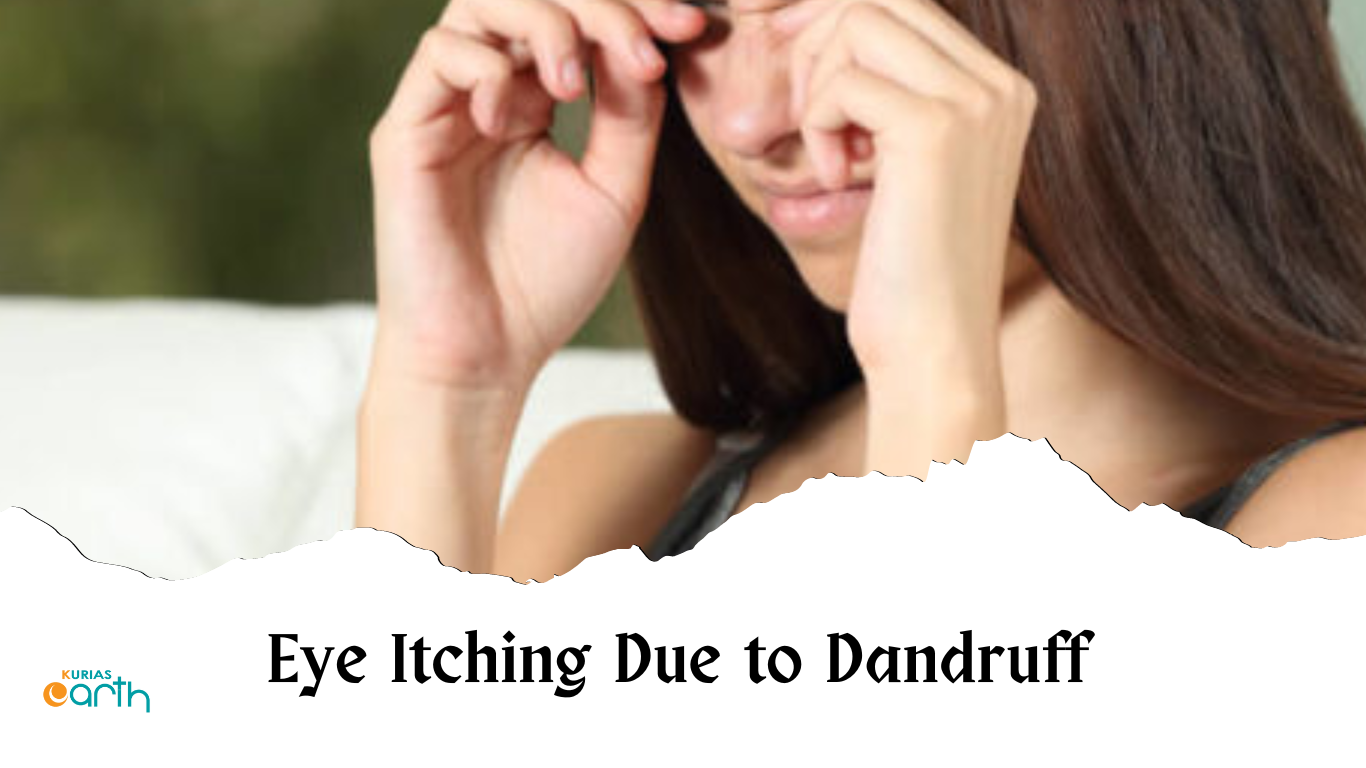 Eye Itching Due to Dandruff