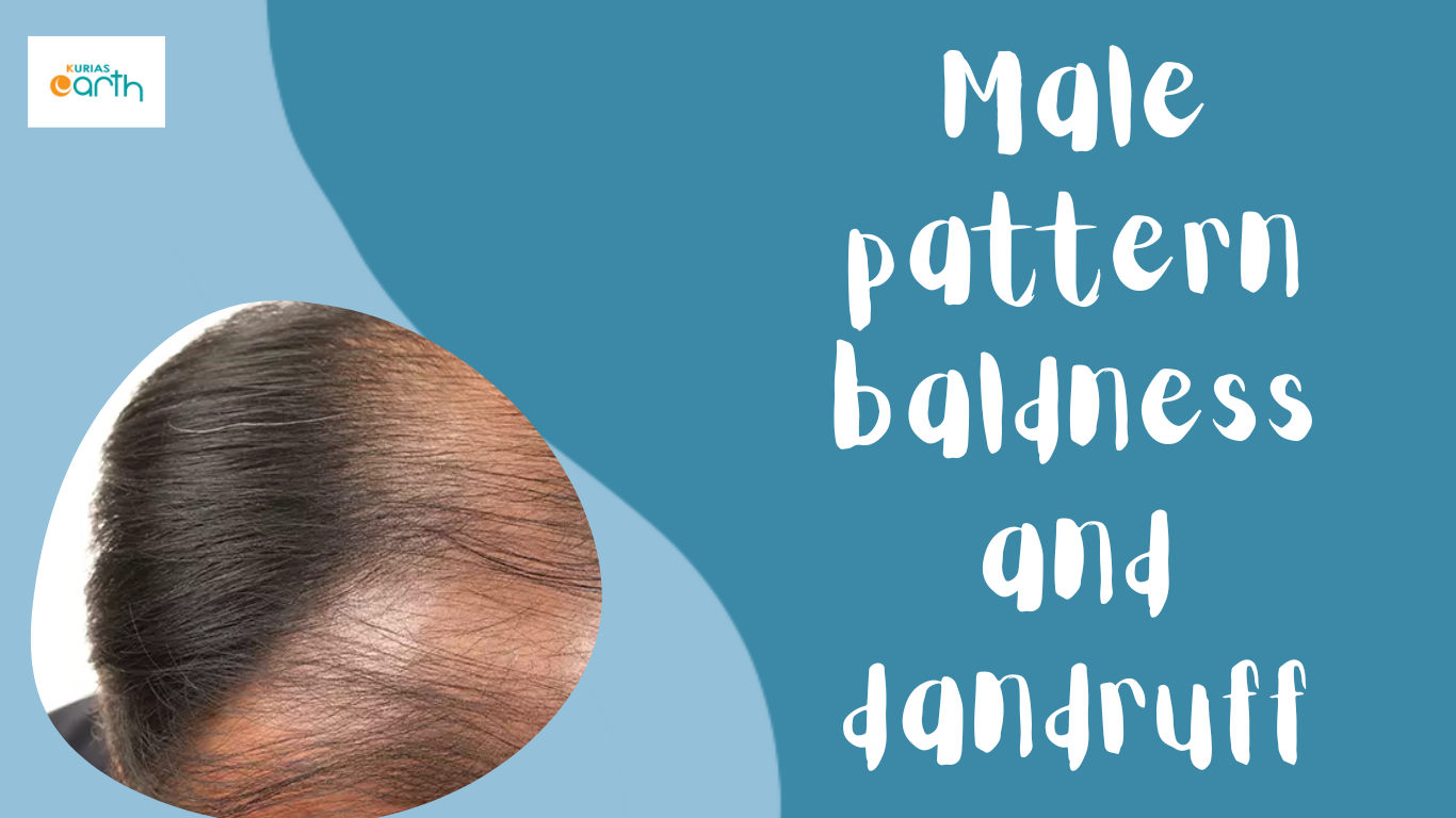 Male pattern baldness and dandruff