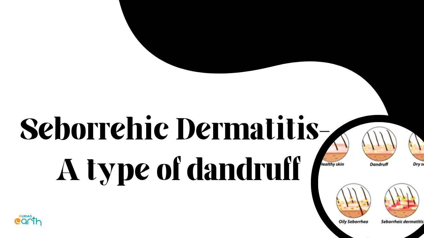 Seborrheic Dermatitis – A Type Of Dandruff