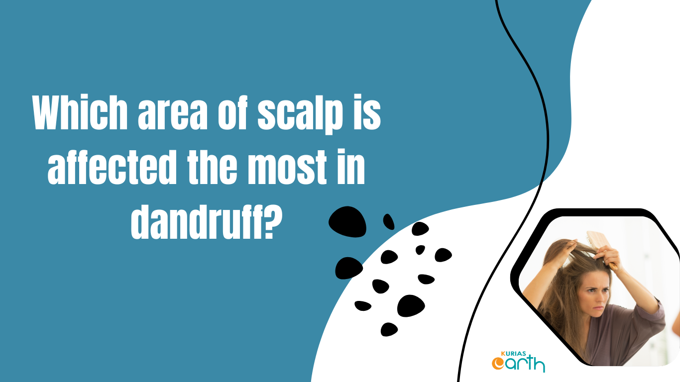 Which area of scalp is affected the most in dandruff?