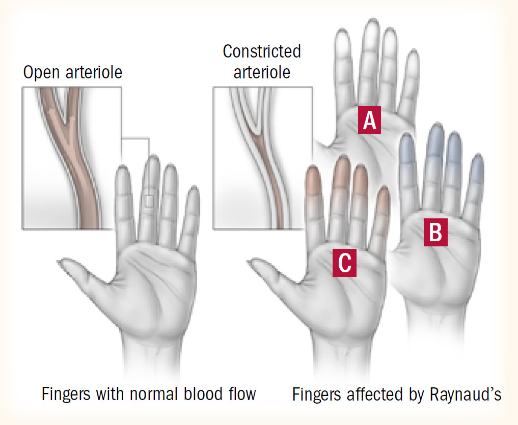 Pathophysiology and clinical features of Raynaud Phenomenon