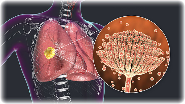 Ayurvedic understanding of Chronic Inflammatory Response Syndrome (CIRS)